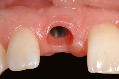 Gum ready for dental implant