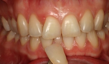 Teeth before whitening procedure