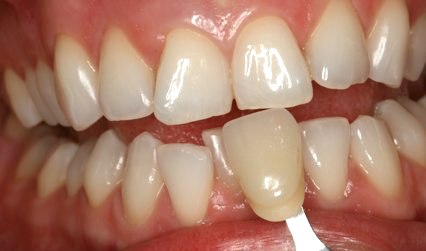 Teeth following whitening procedure
