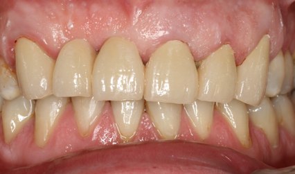 teeth with new bridge in place