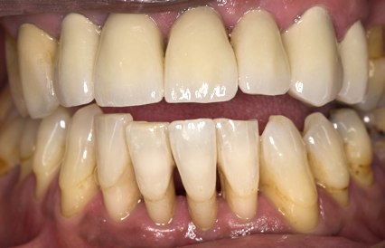 teeth after caps and crowns fitted
