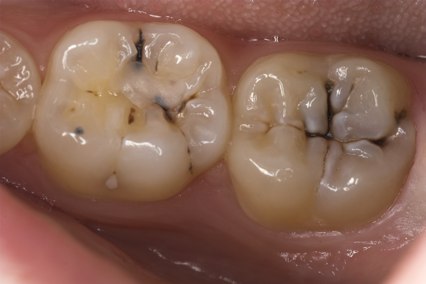 Teeth in need of fillings
