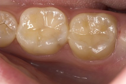 teeth following colour-matched fillings