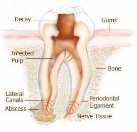 drawing of tooth, root and gums showing decayed area