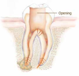 drawing of tooth, root and gums with decay cleaned out