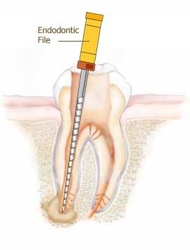 diagram of endontic file in dental root
